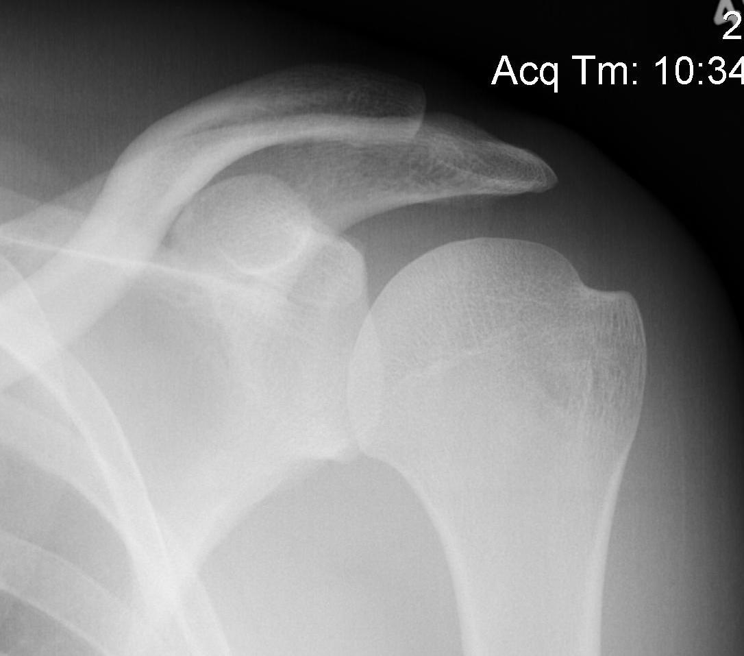 Shoulder AP Xray